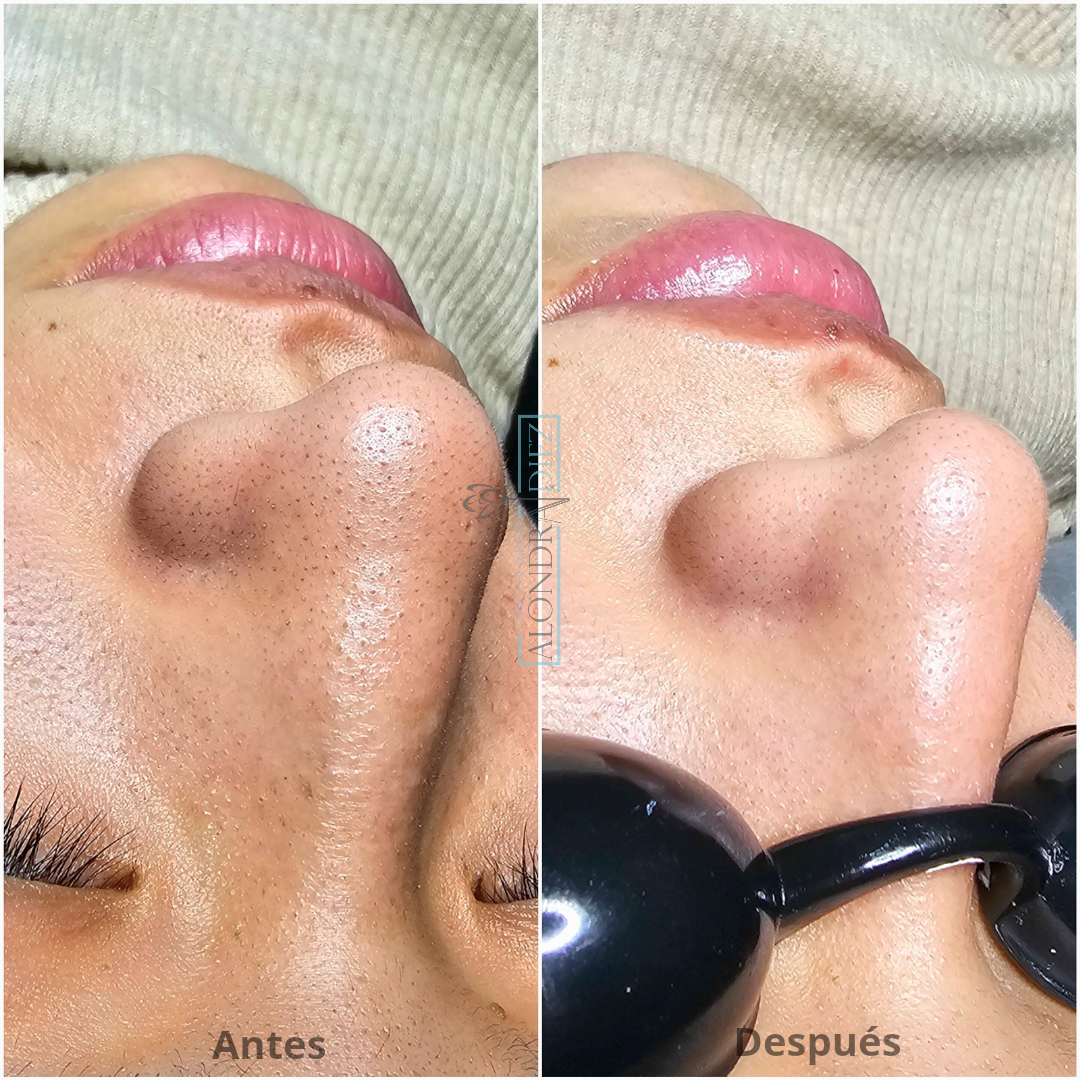 Antes y después de un facial