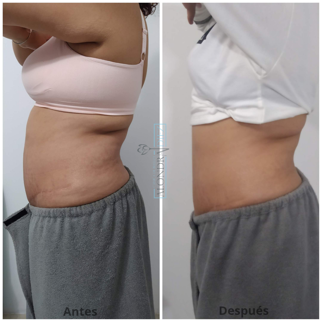Antes y después de un tratamiento reductivo