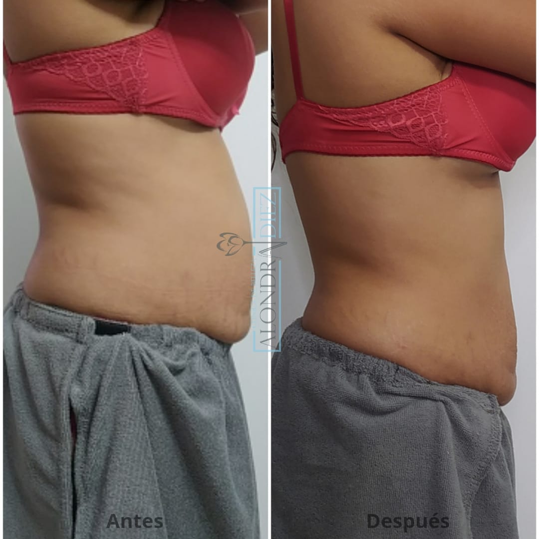 Antes y después de un tratamiento reductivo