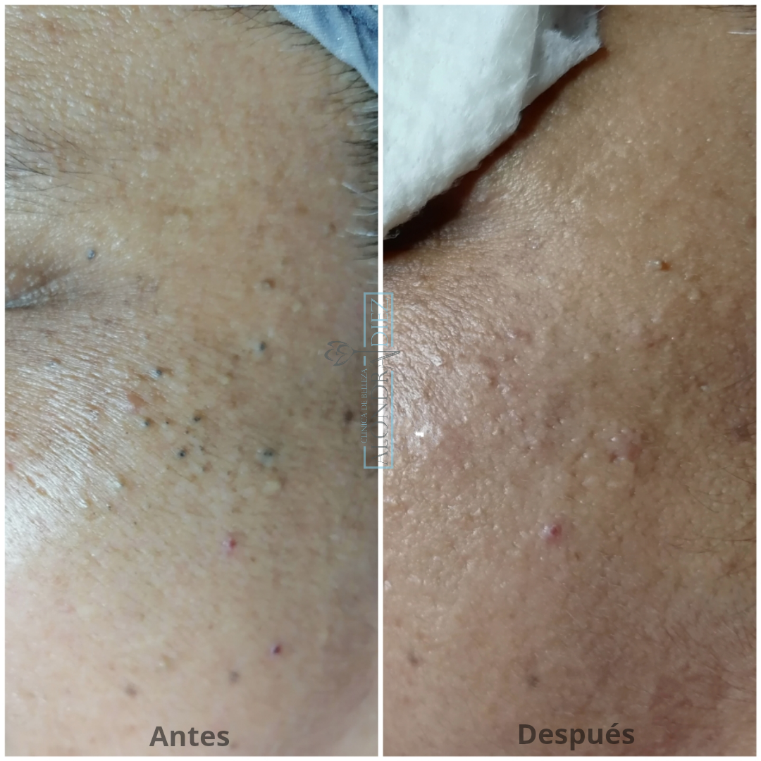 Antes y después de un tratamiento de piel